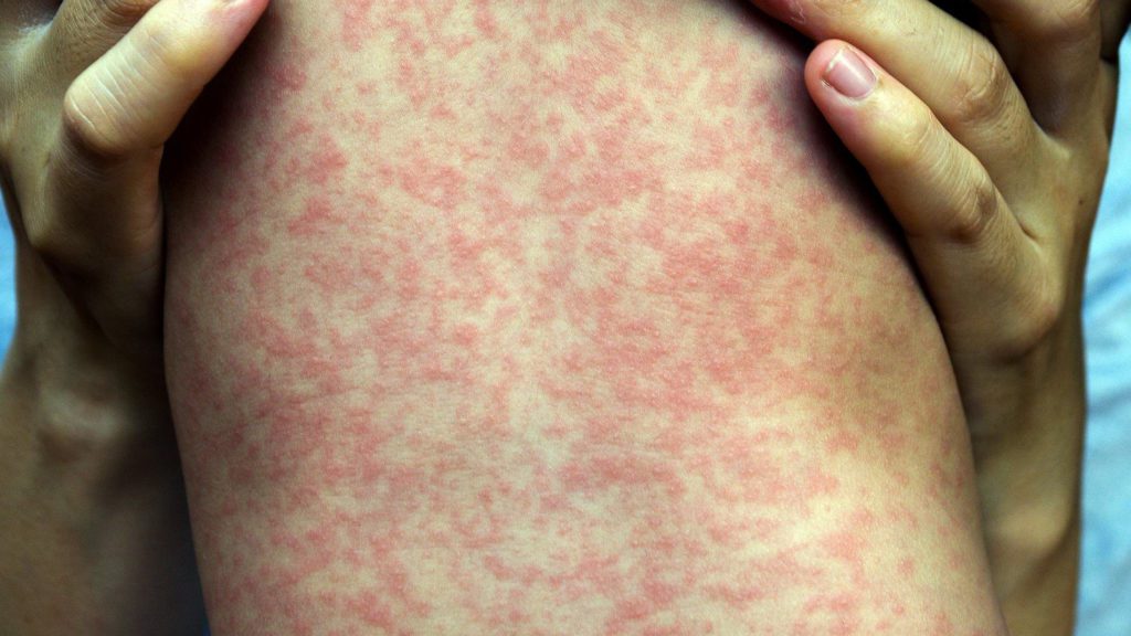 a person with red rash on their skin