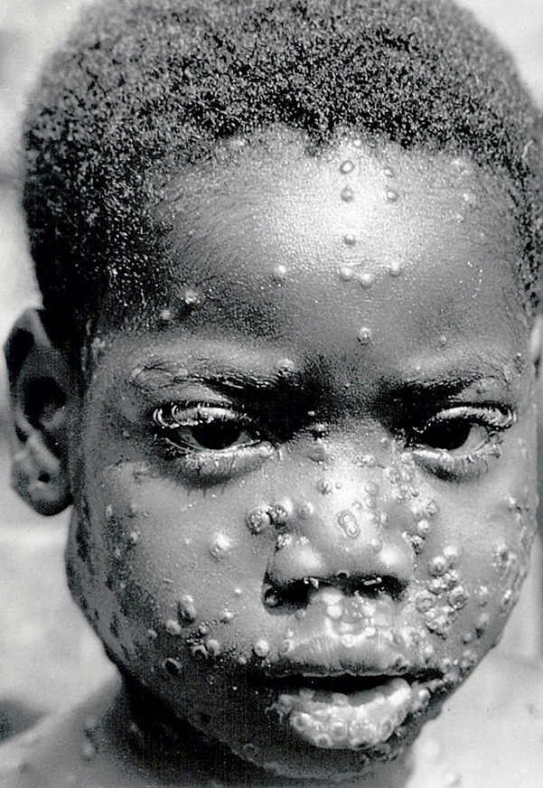 a close-up of a child with chicken pox
